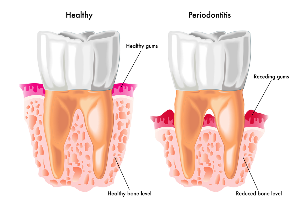 Bilde av forklaring til periodontit
