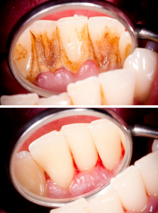 Bilde av periodontitet tegn